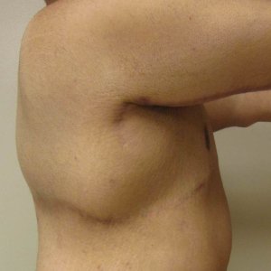 manhattan gynecomastia surgery after 7